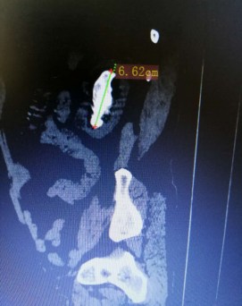 单通道微创手术一次性取出6cm巨大肾铸型结石