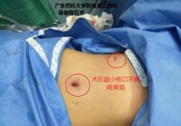 深圳19岁女工患胆囊结石 切除整个胆囊还是保留胆囊取结石？