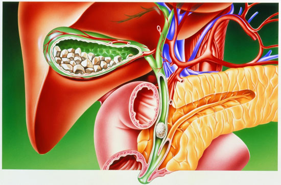胆管结石会造成哪些影响？