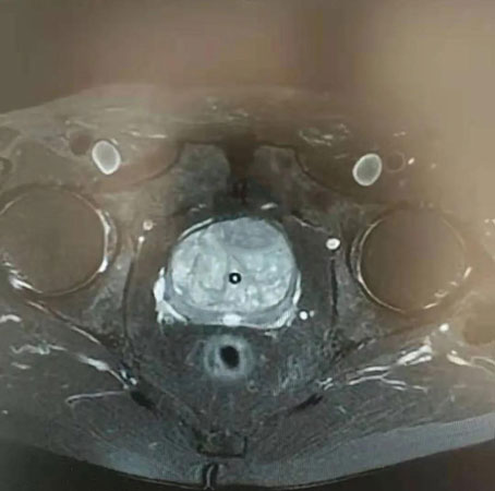 江苏盐城临床中心正式运营，完成首例软镜取石及前列腺增生手术