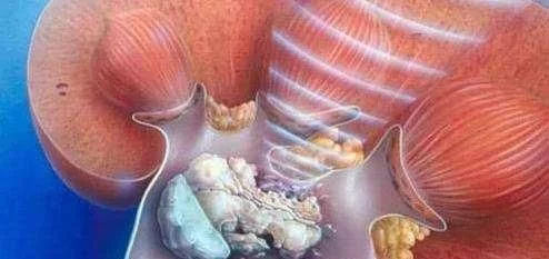 肾结石是怎么形成的？饮食上要注意什么